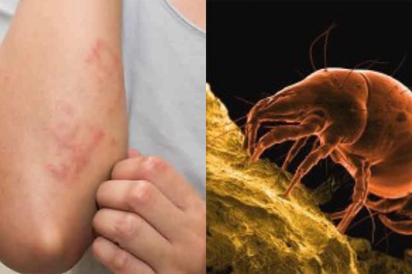 რა არის მუნი და როგორ დავიცვათ თავი გადამდები სენისგან